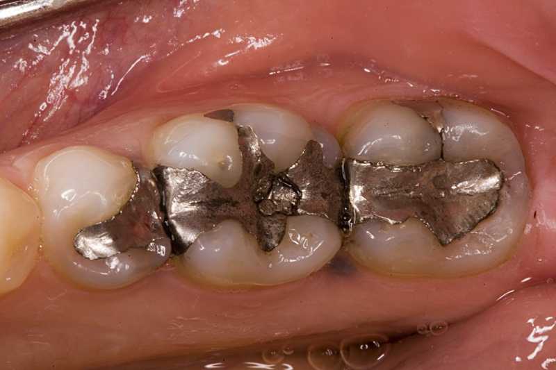 انواع مختلف مواد پر کننده دندان