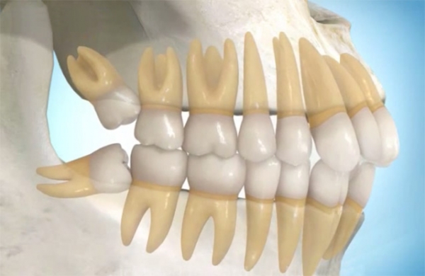دندان عقل نیمه نهفته