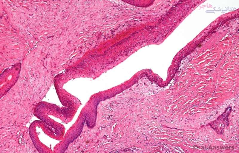 odontogenic-keratocyst