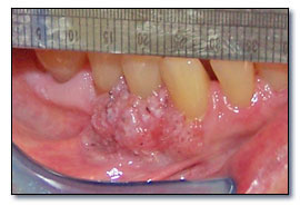 کارسینوم درجا (Carcinoma in situ)