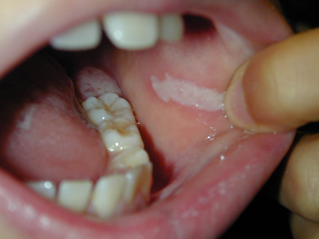 استوماتیت نیکوتین (Nicotine stomatitis)