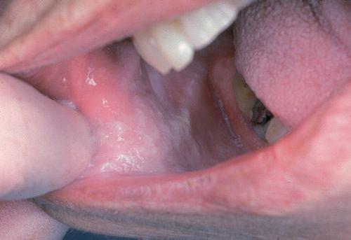 خال سفید اسفنجی (White sponge nevus)