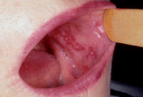 لوکوادما (Leukoedema)