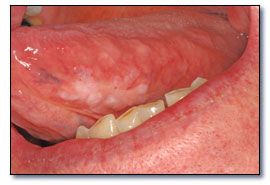 دیسپلازی اپی تلیال (Epithelial dysplasia)