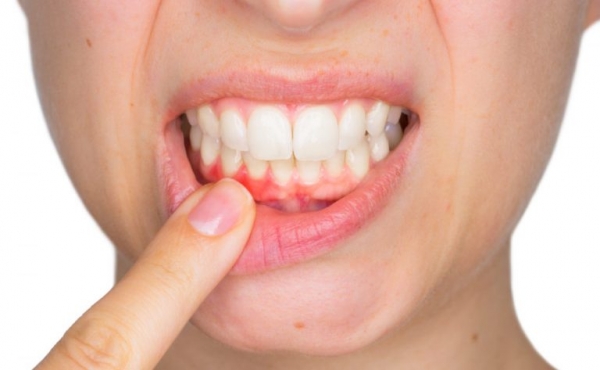 بیماری های غیر منتظره متاثر از بیماری لثه