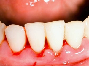علائم خون ریزی لثه و سلامتی شما