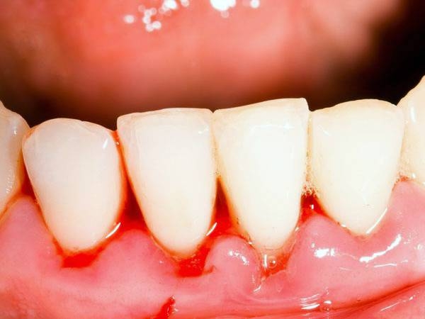 علائم خون ریزی لثه و سلامتی شما