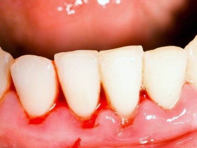 علائم خون ریزی لثه و سلامتی شما