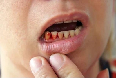 بیماری های لثه چگونه هستند؟