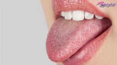 علت خشکی دهان چیست؟